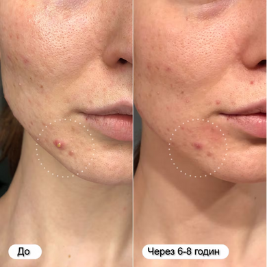 Фото Пластир від прищів Hero Cosmetics Mighty Patch Original 36